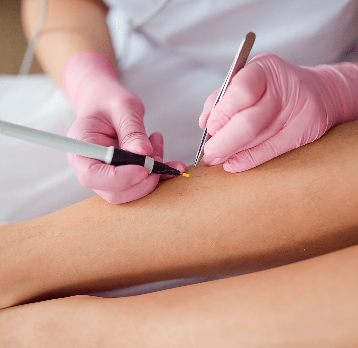 Curettage and Cautery